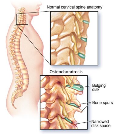 osteocondrosi cervicale