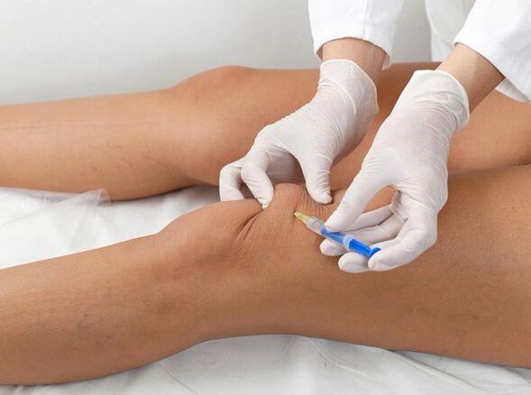 iniezione intra-articolare per l'artrosi del ginocchio