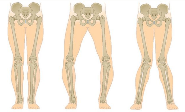 complicanze dell’artrosi del ginocchio